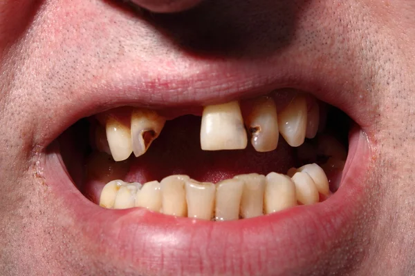 Kötü diş sigara içen