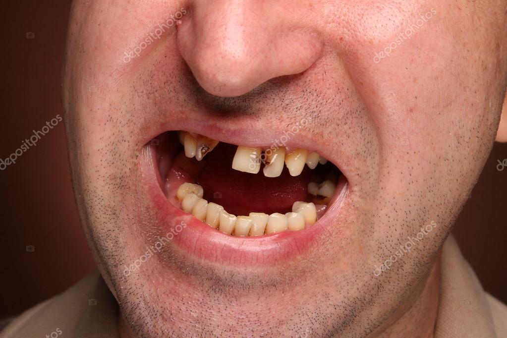 Зубы Курящих Фото