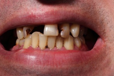 Kötü diş sigara içen