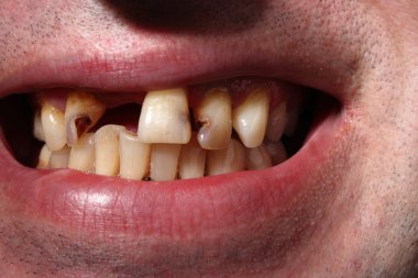 Kötü diş sigara içen