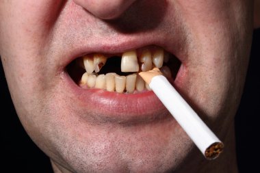 Kötü diş sigara içen
