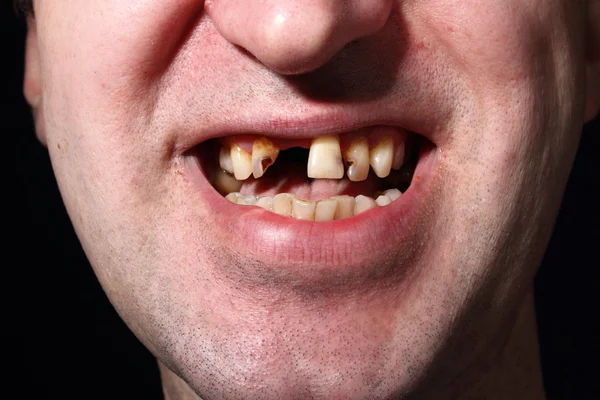 Kötü diş sigara içen