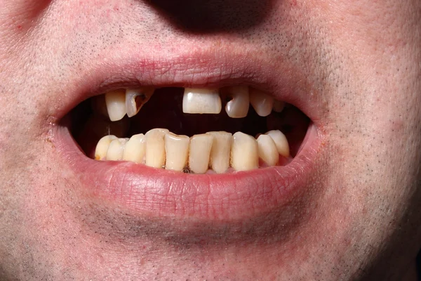 Kötü diş sigara içen