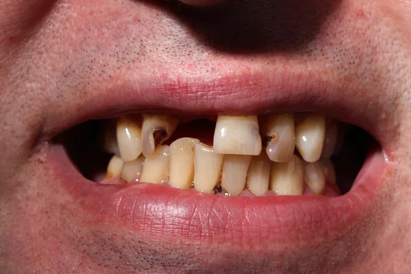 Kötü diş sigara içen