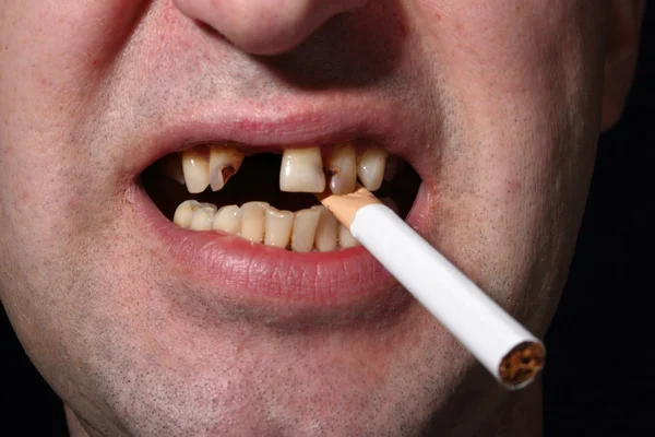 Bad teeth smoker — Stock Photo, Image
