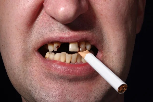 Bad teeth smoker — Stock Photo, Image