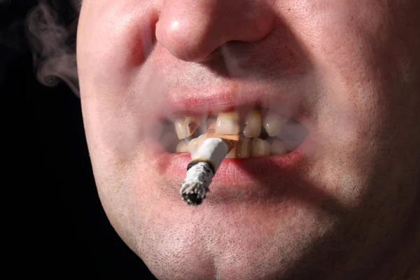 Bad teeth smoker — Stock Photo, Image