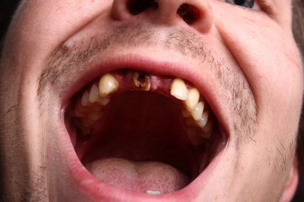 Dientes malos — Foto de Stock