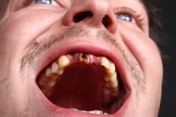 Schlechte Zähne — Stockfoto