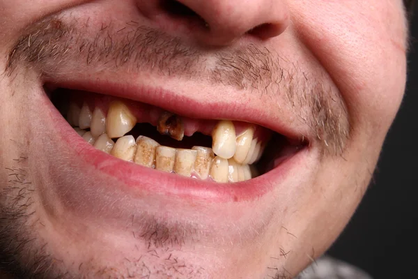 Плохие зубы — стоковое фото