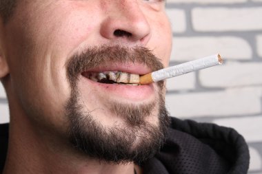 Kötü diş sigara içen hasta