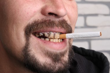 Kötü diş sigara içen hasta