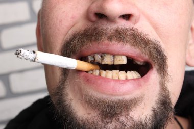 Kötü diş sigara içen hasta