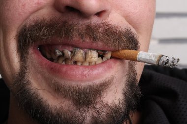 Kötü diş sigara içen hasta