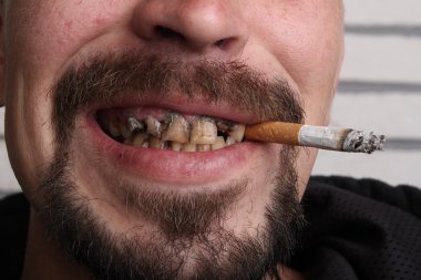 Kötü diş sigara içen hasta