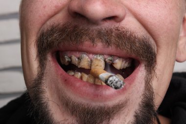 Kötü diş sigara içen hasta