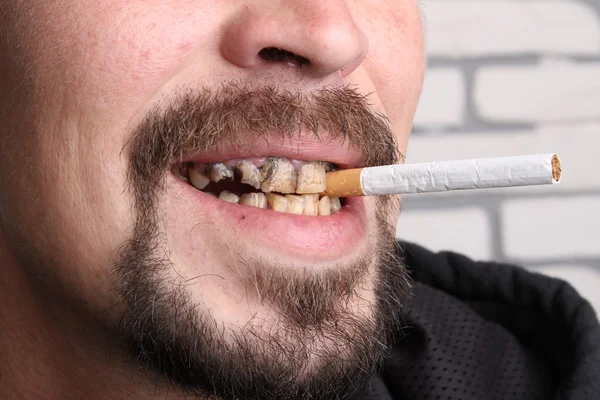 Kötü diş sigara içen hasta