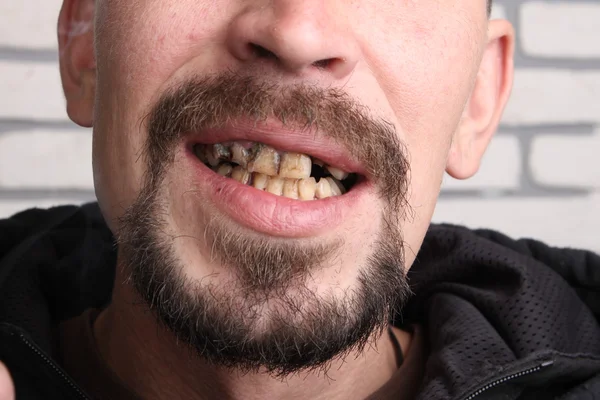 Плохие зубы курильщик болен — стоковое фото