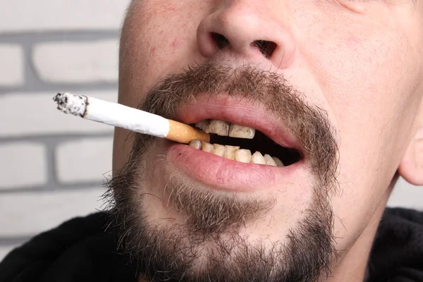 Denti cattivi fumatore malato — Foto Stock