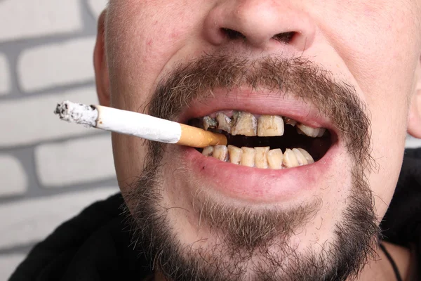 Dåliga tänder rökare sjukt — Stockfoto