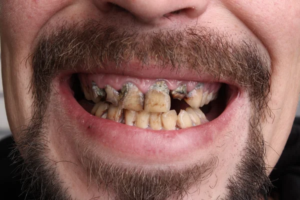 Kötü diş sigara içen hasta — Stok fotoğraf