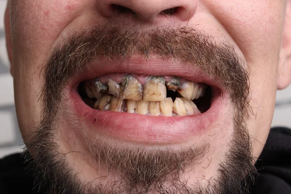 Schlechte Zähne Raucher krank — Stockfoto
