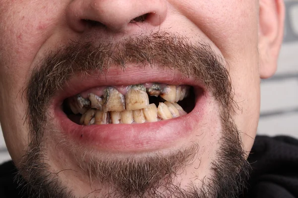 Kötü diş sigara içen hasta