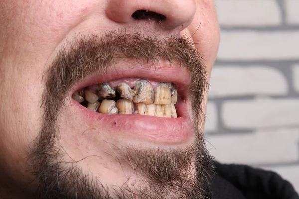Плохие зубы курильщик болен — стоковое фото