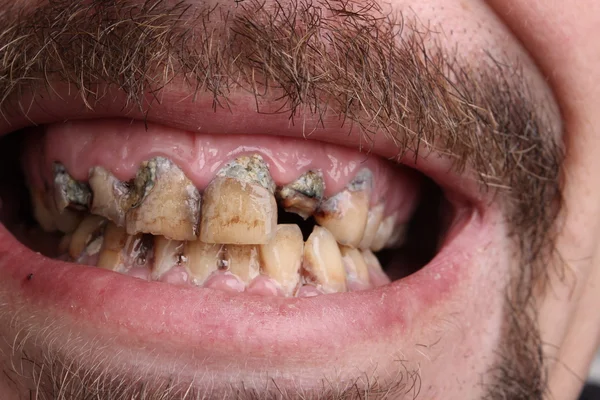 Rossz fogak dohányos beteg — Stock Fotó