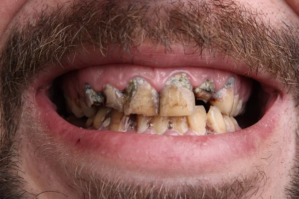 Zepsute zęby palacz chory — Zdjęcie stockowe
