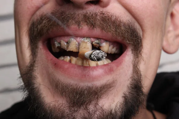 Denti cattivi fumatore malato — Foto Stock