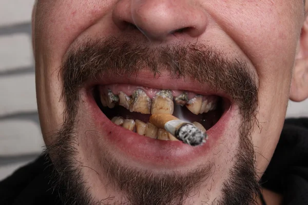 Kötü diş sigara içen hasta