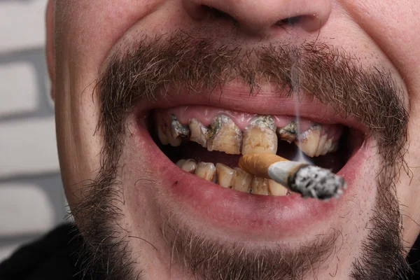 Bad teeth smoker sick — Stock Photo, Image