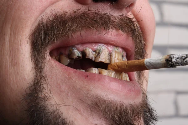 Bad teeth smoker sick — Stock Photo, Image