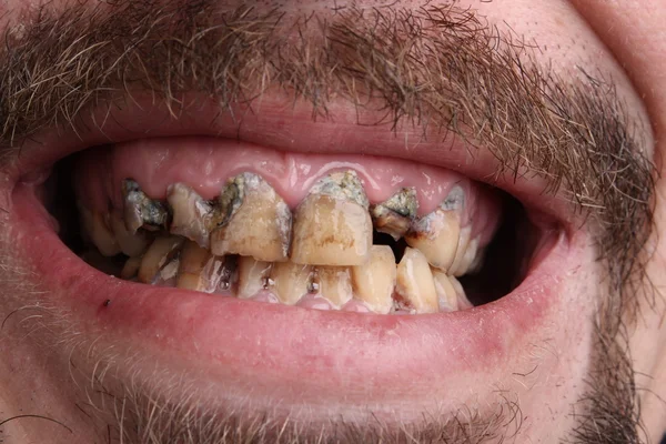 Schlechte Zähne Raucher krank Stockfoto