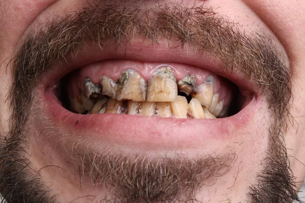 Schlechte Zähne Raucher krank Stockbild