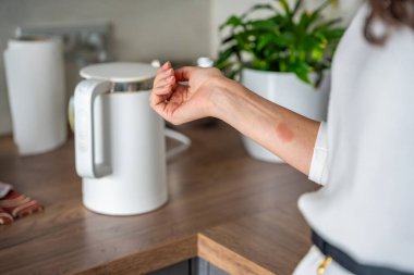 Mutfaktaki su ısıtıcısından çıkan buharın yol açtığı kafa derisi yanığı. Sıcak ev aletlerinin tehlikesini gösteren bir ev kazası. Yüksek kalite fotoğraf