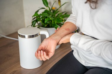 Mutfaktaki su ısıtıcısından çıkan buharın yol açtığı kafa derisi yanığı. Sıcak ev aletlerinin tehlikesini gösteren bir ev kazası. Yüksek kalite fotoğraf