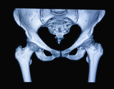 MRI scan of the hip joint clipart