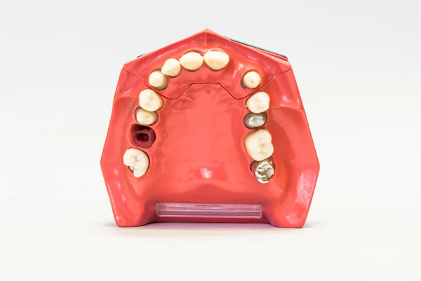 Dentaduras dentárias isoladas em branco — Fotografia de Stock