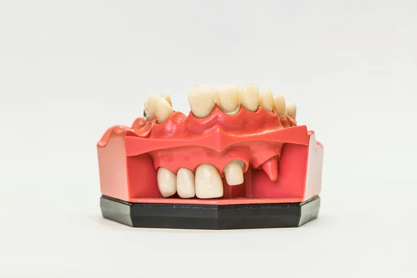 Protezy dentystyczne na białym tle — Zdjęcie stockowe