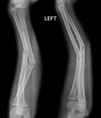 RADIUS ve ulnar kemik, röntgen filmi şaft kırığı