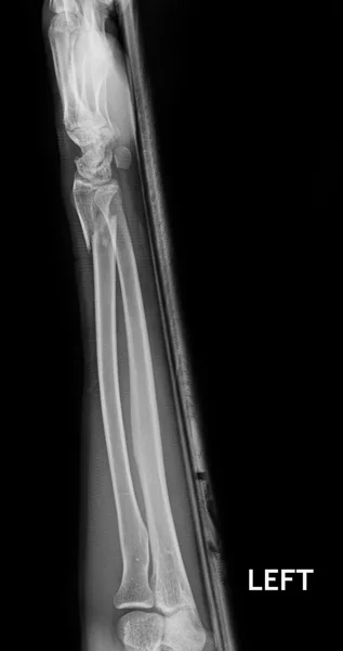 Fracture shaft of radius & ulnar bone, x-ray film — Stock Photo, Image