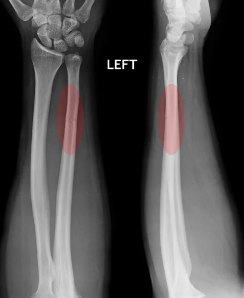 Fracture shaft of radius & ulnar bone, x-ray film — Stock Photo, Image