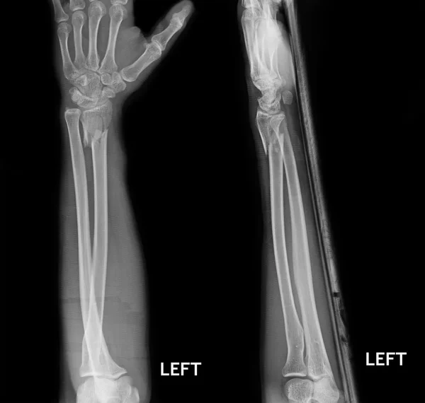 Fracture Elbow, forearm xrays image showing plate and screw fixation