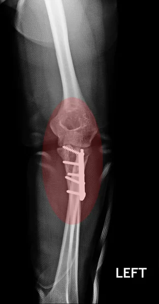 Fratura Cotovelo, imagem de raios-x do antebraço mostrando placa e fixação do parafuso — Fotografia de Stock