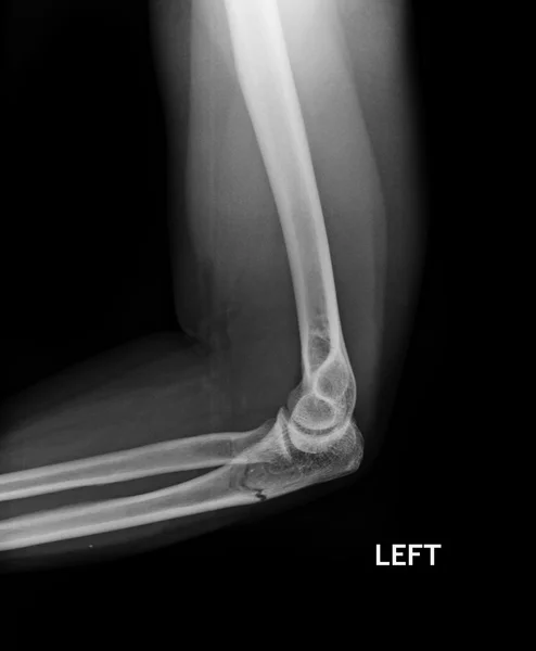 Codo de fractura, imagen de rayos X del antebrazo que muestra fijación de placa y tornillo — Foto de Stock