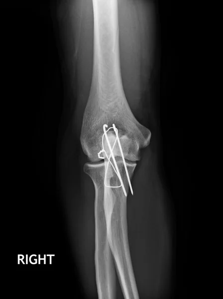 Codo de fractura, imagen de rayos X del antebrazo que muestra fijación de placa y tornillo — Foto de Stock