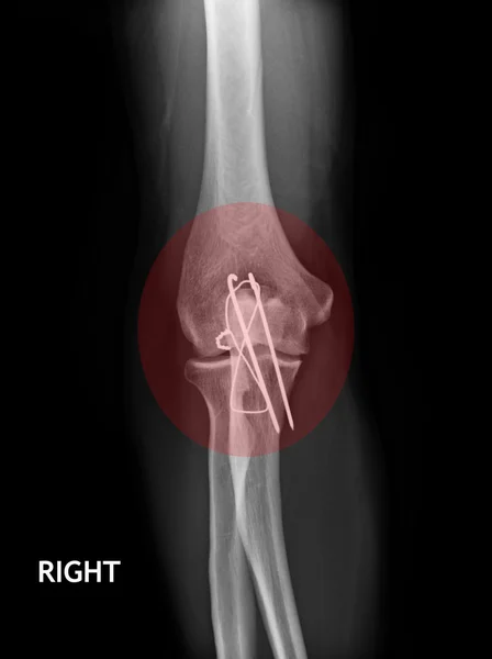 Codo de fractura, imagen de rayos X del antebrazo que muestra fijación de placa y tornillo — Foto de Stock