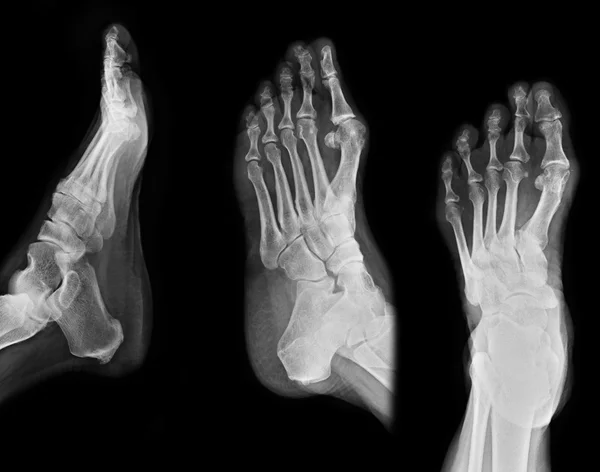 Radiographie du pied — Photo